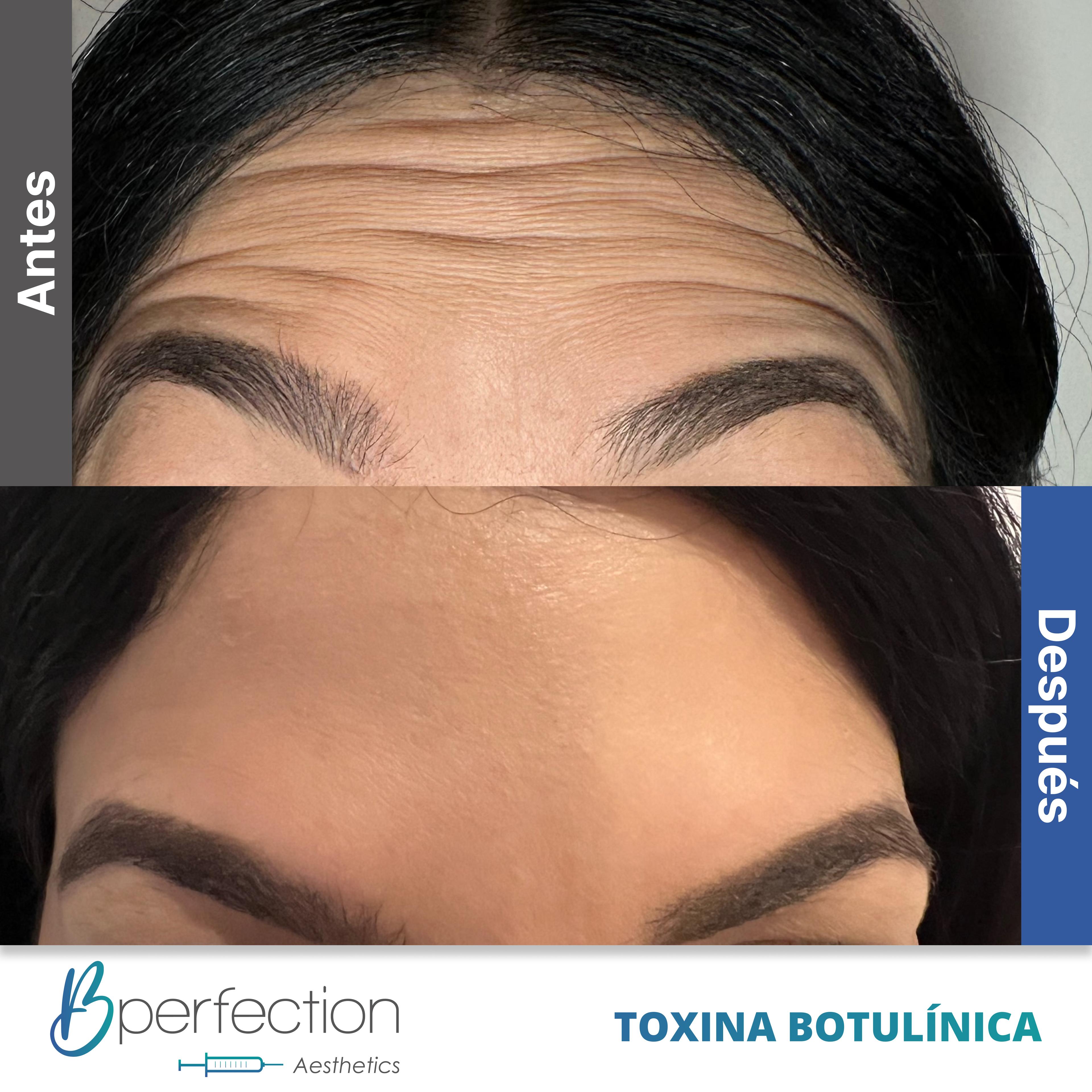 Resultado Botox 1