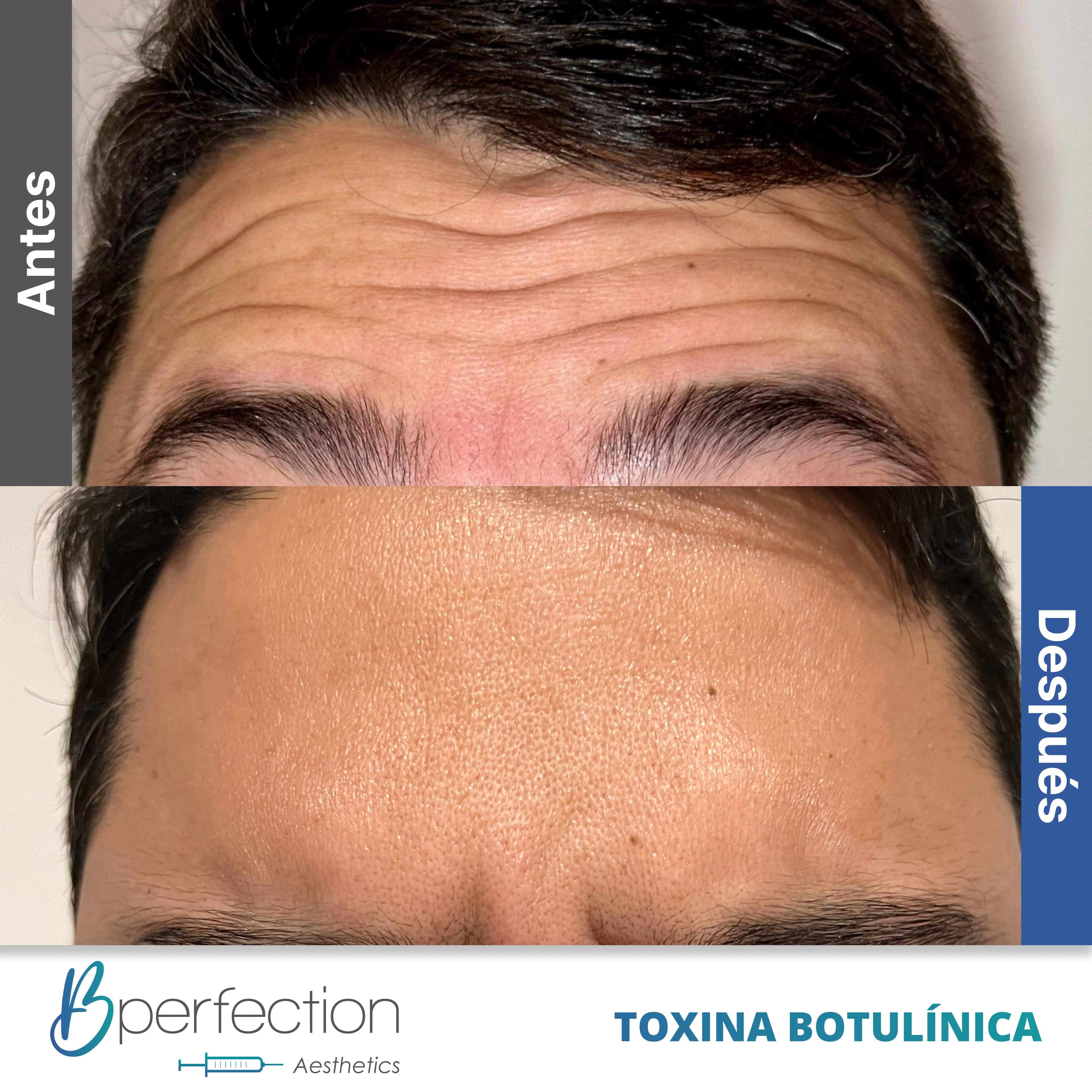 Resultado Botox 2