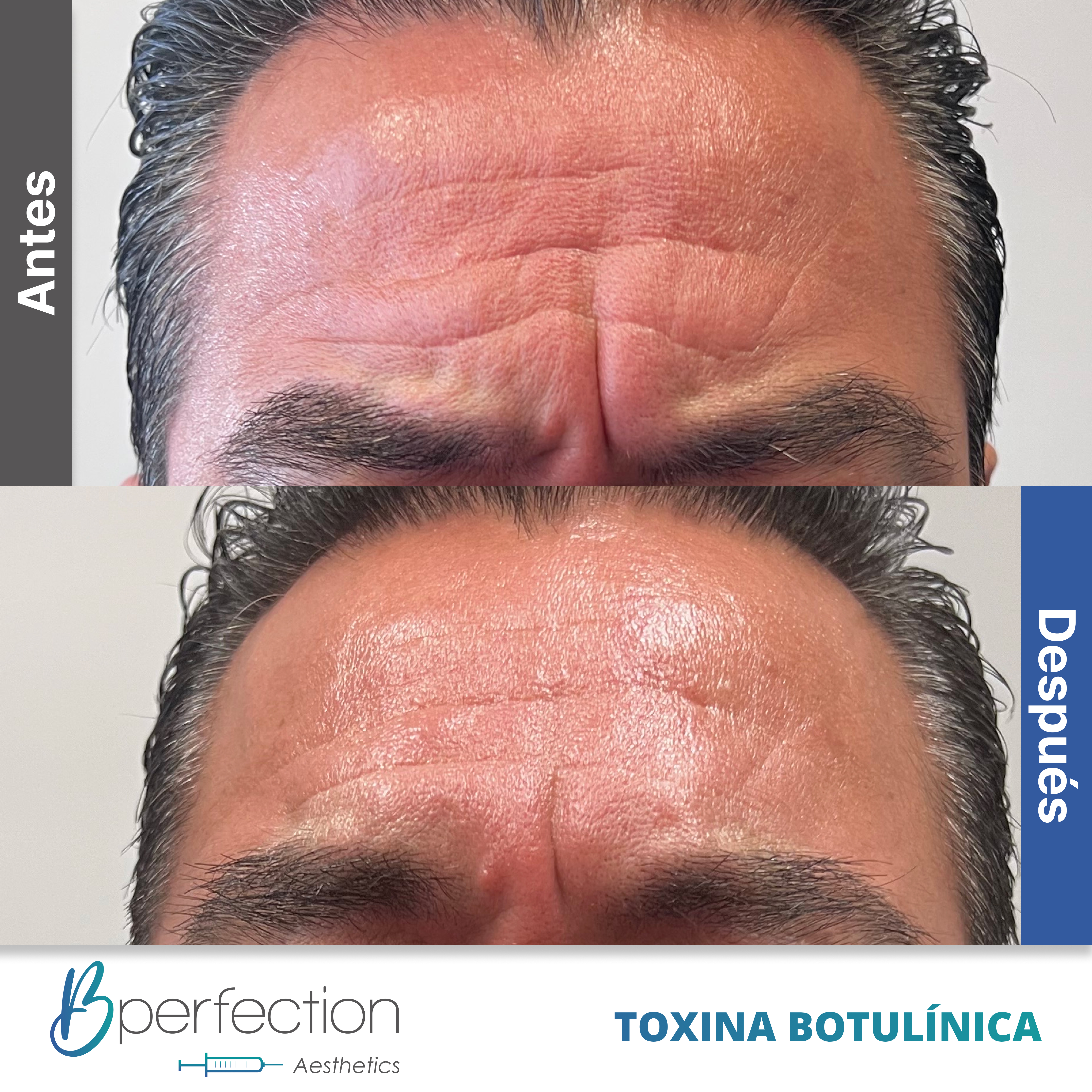 Resultado Botox 3