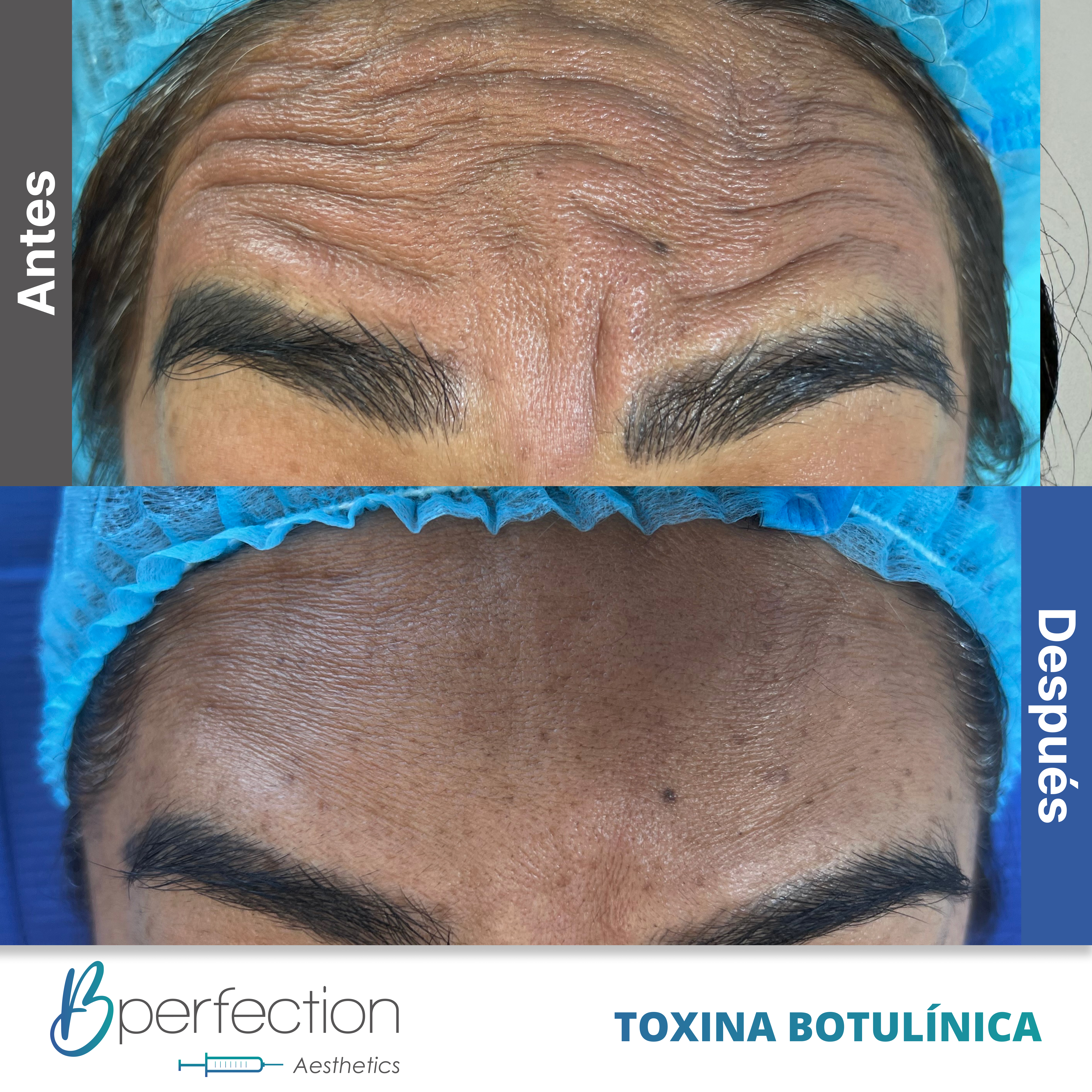 Resultado Botox 4