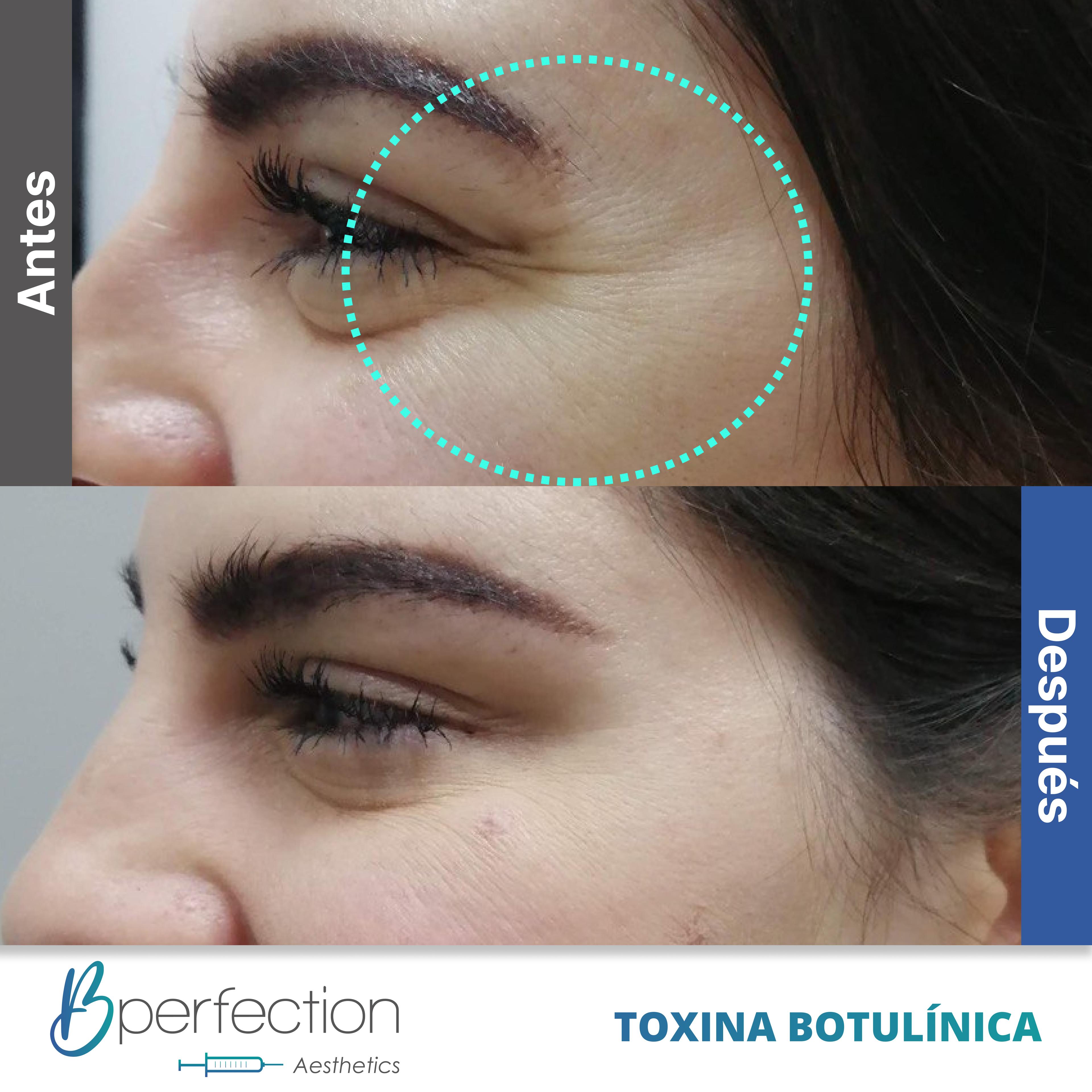 Resultado Botox 5