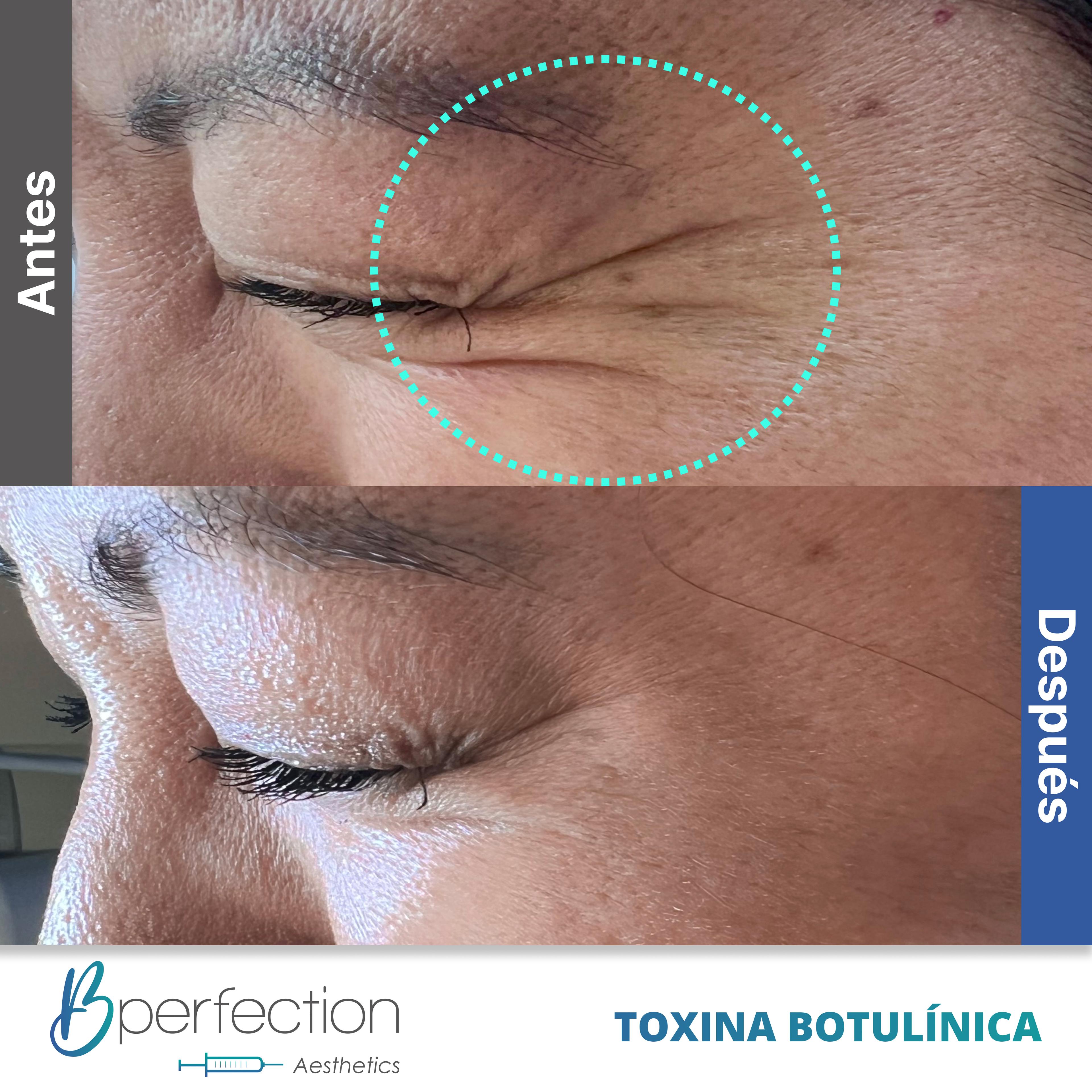Resultado Botox 6