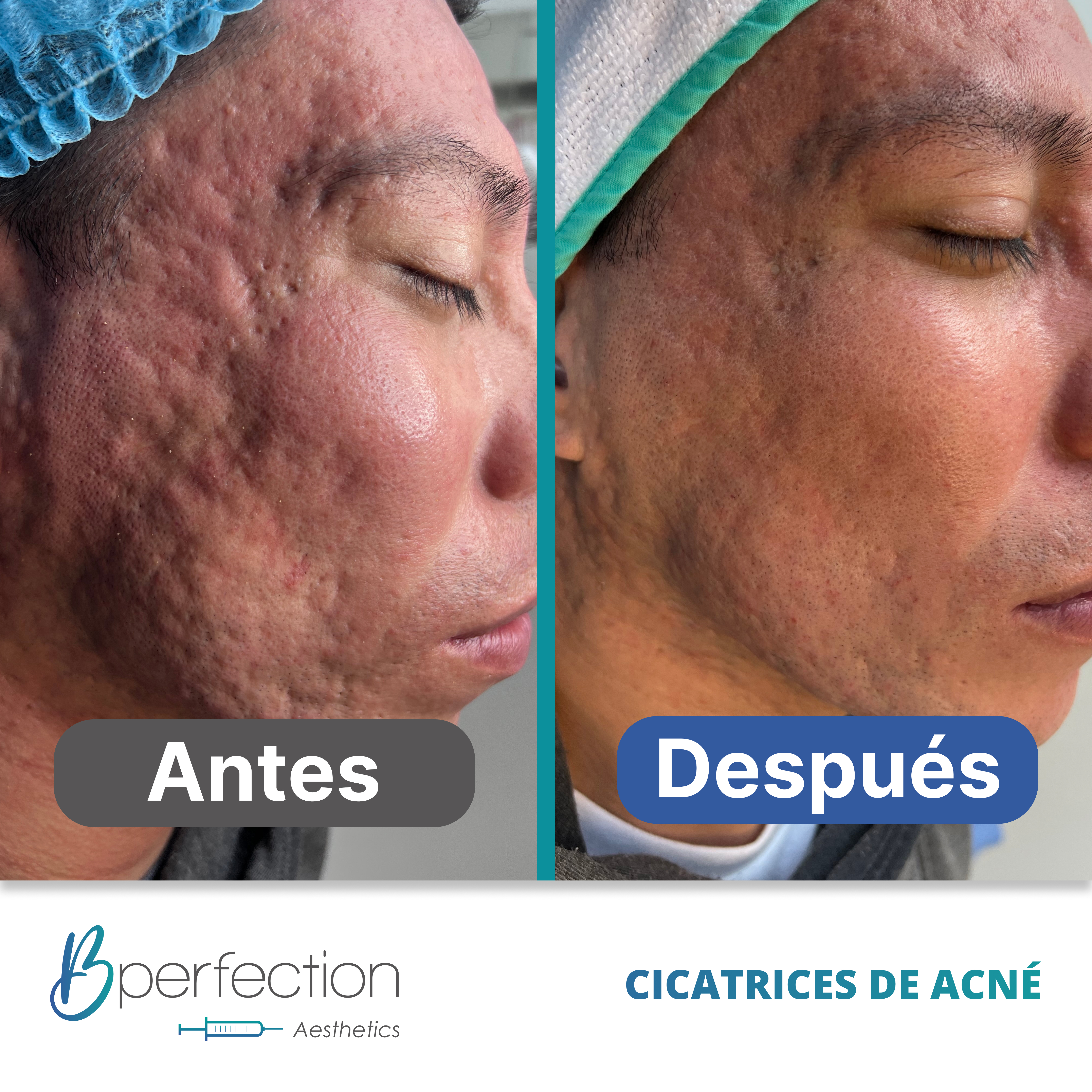 Resultado Cicatriz 1