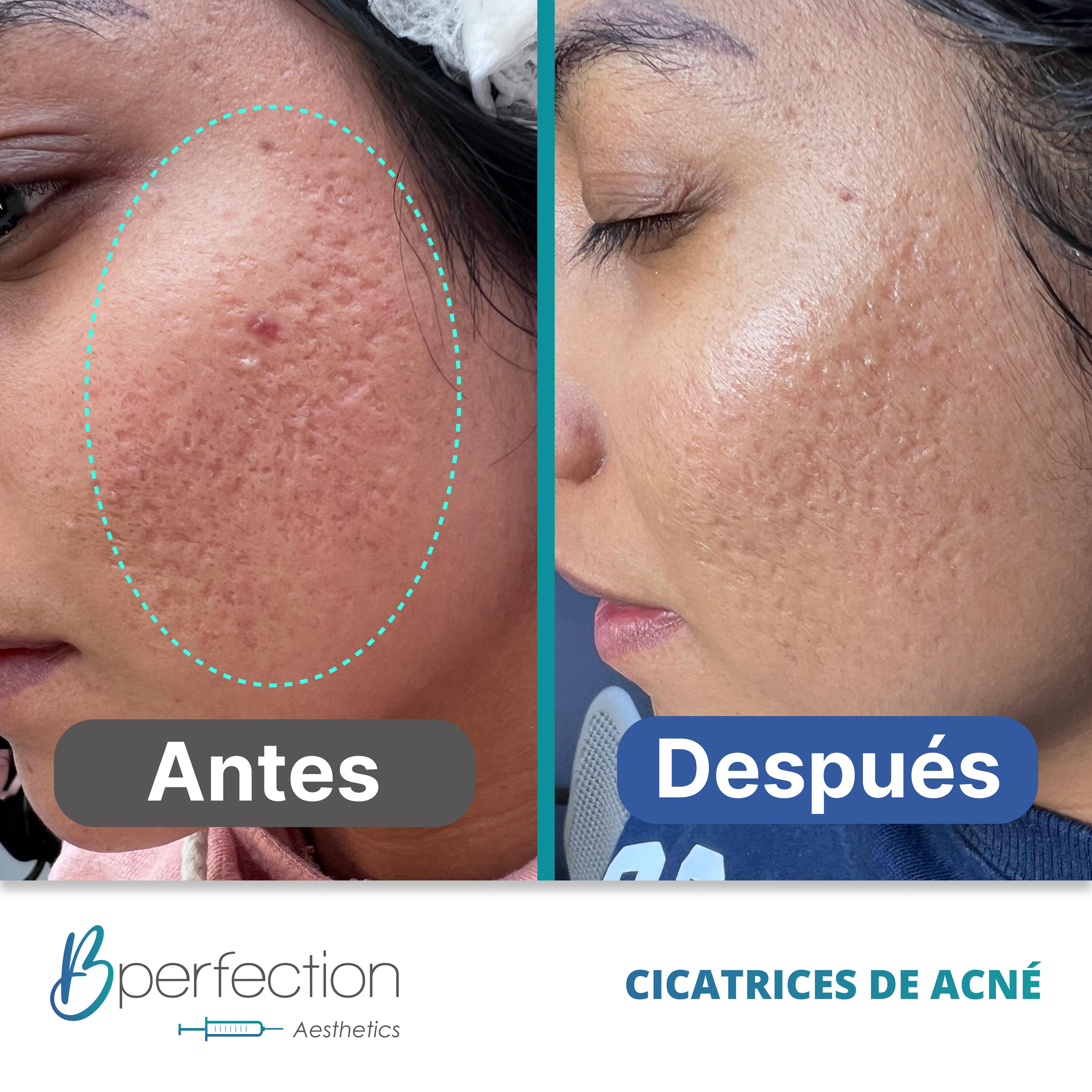 Resultado Cicatriz 2