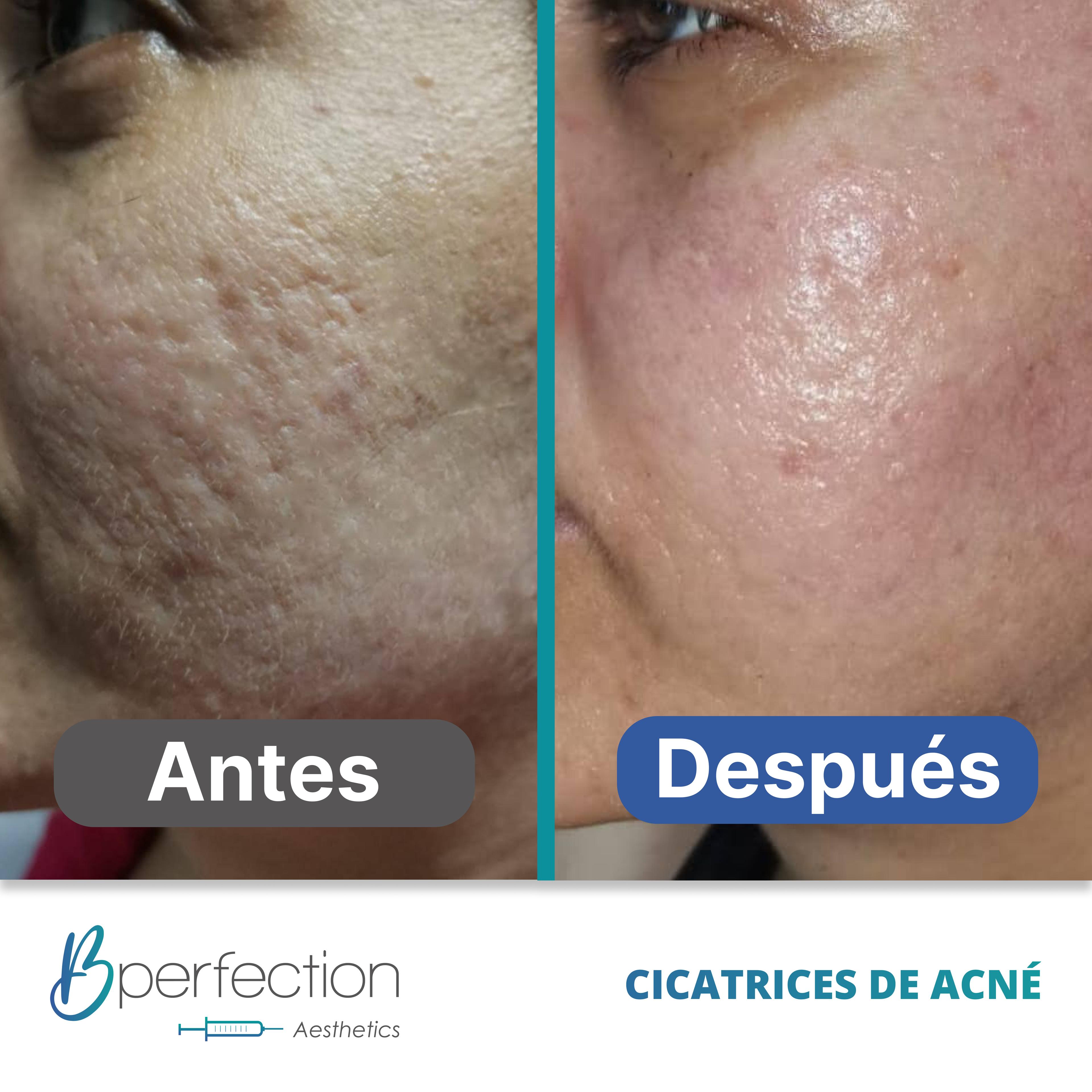 Resultado Cicatriz 3