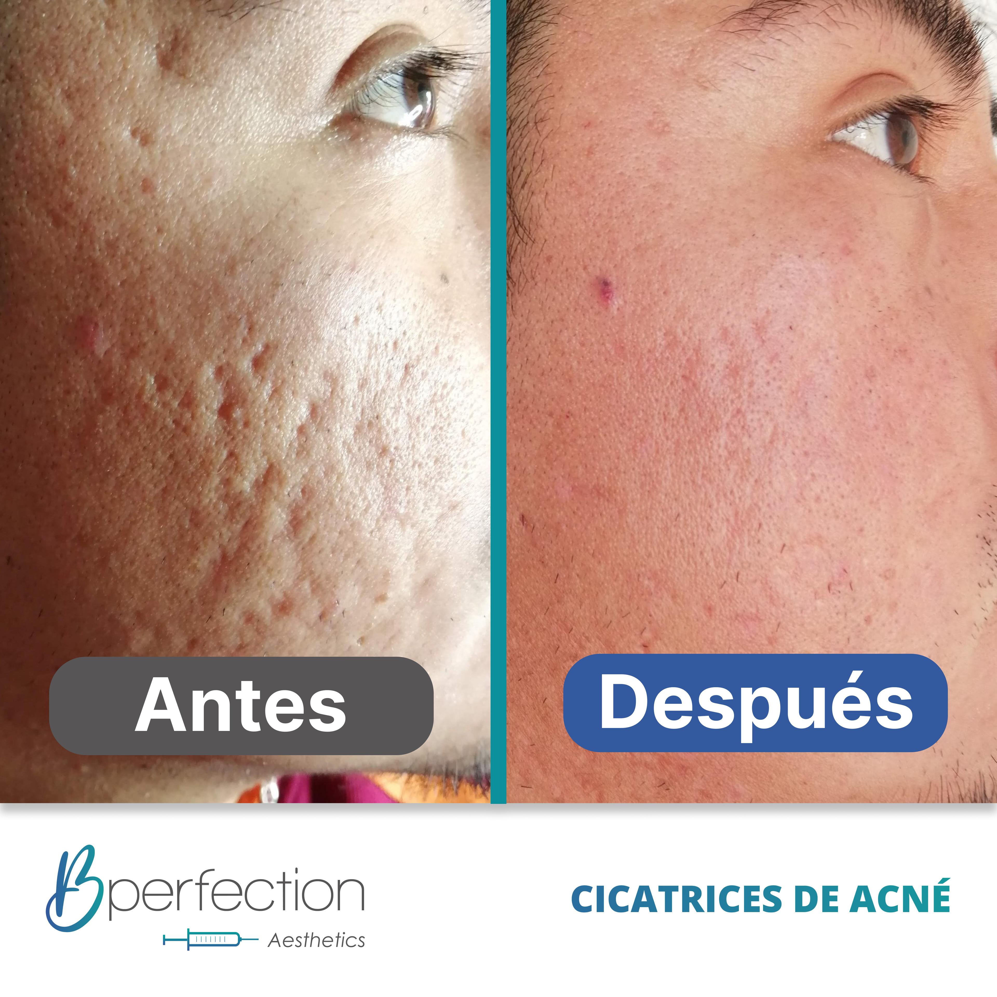 Resultado Cicatriz 4