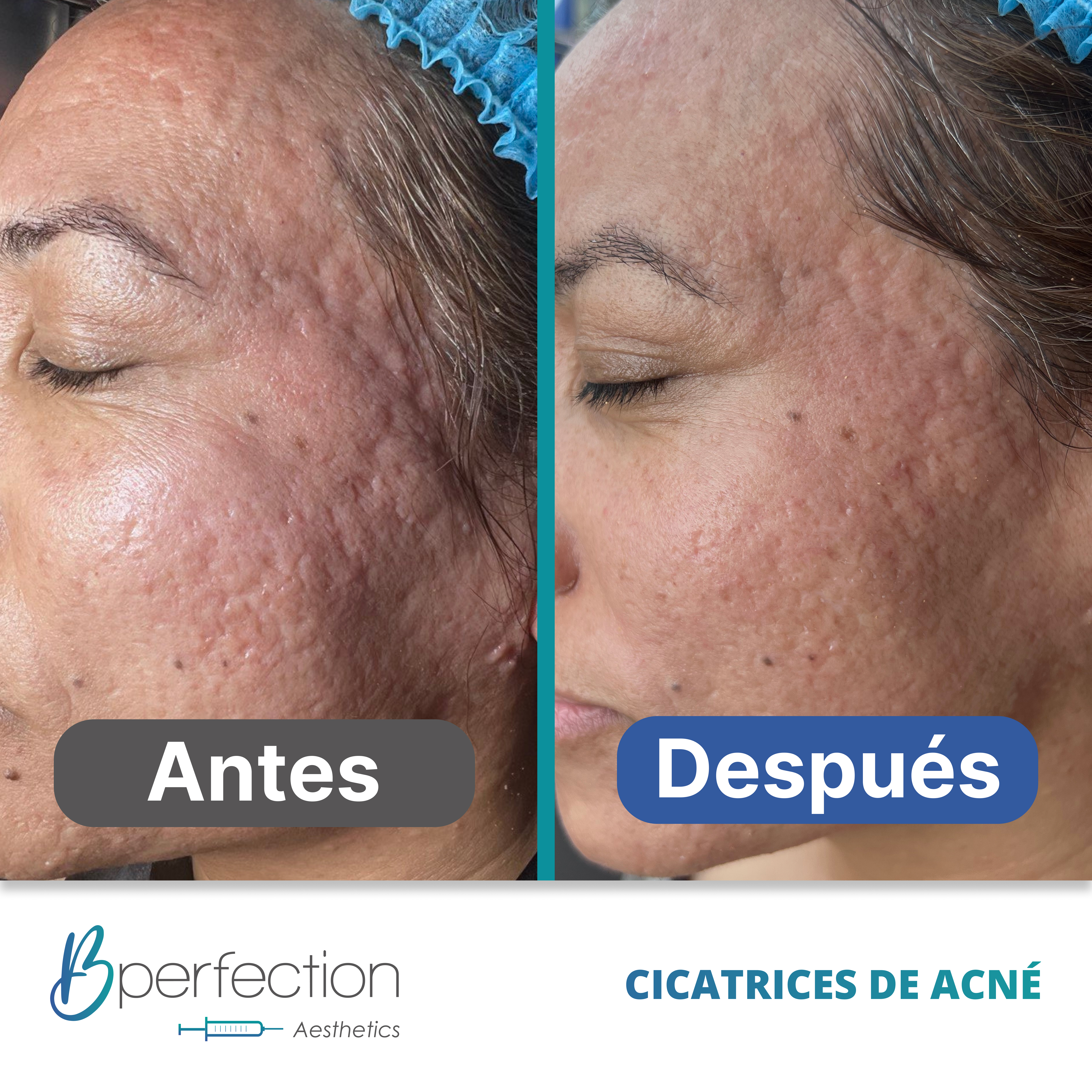 Resultado Cicatriz 5