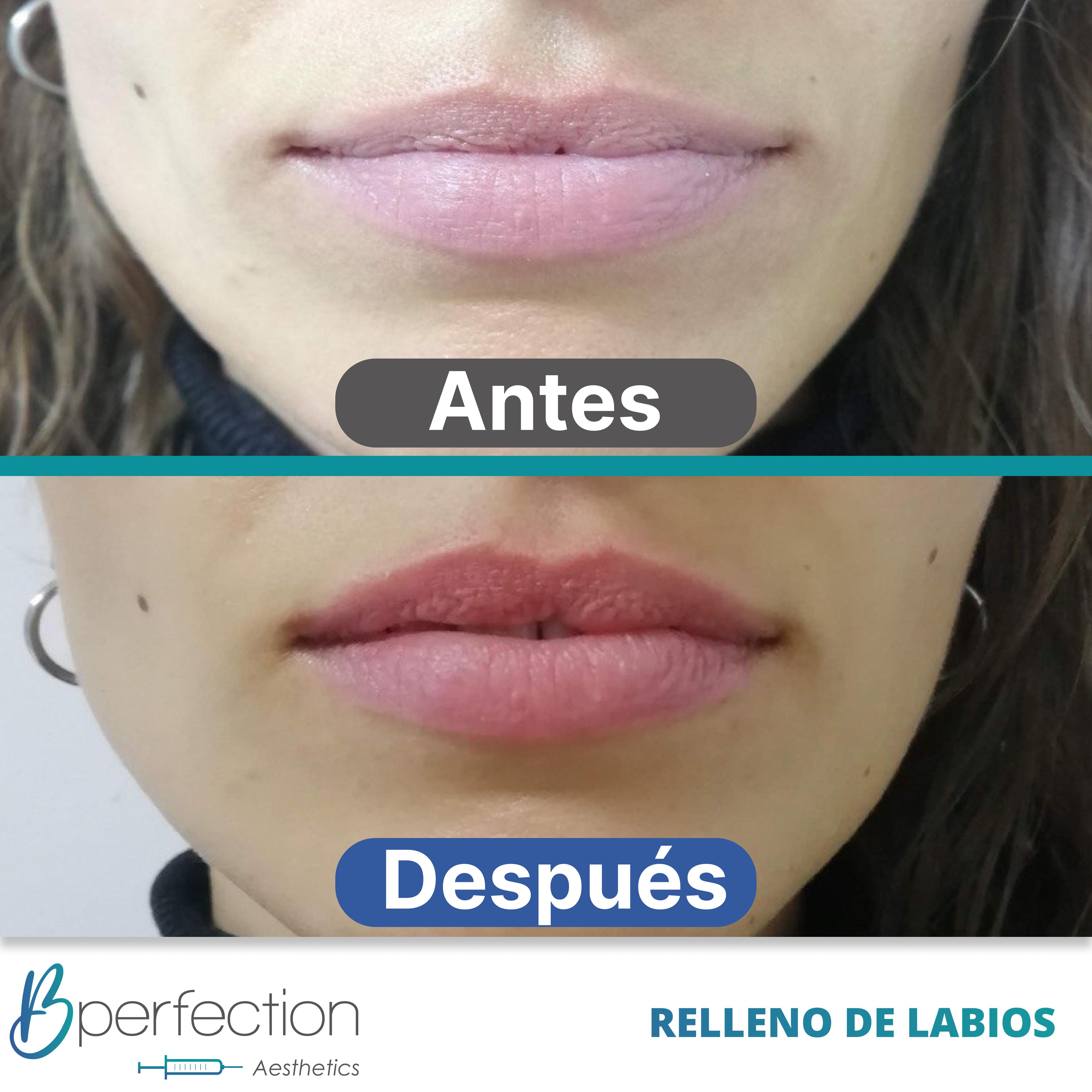 Resultado Labios 1