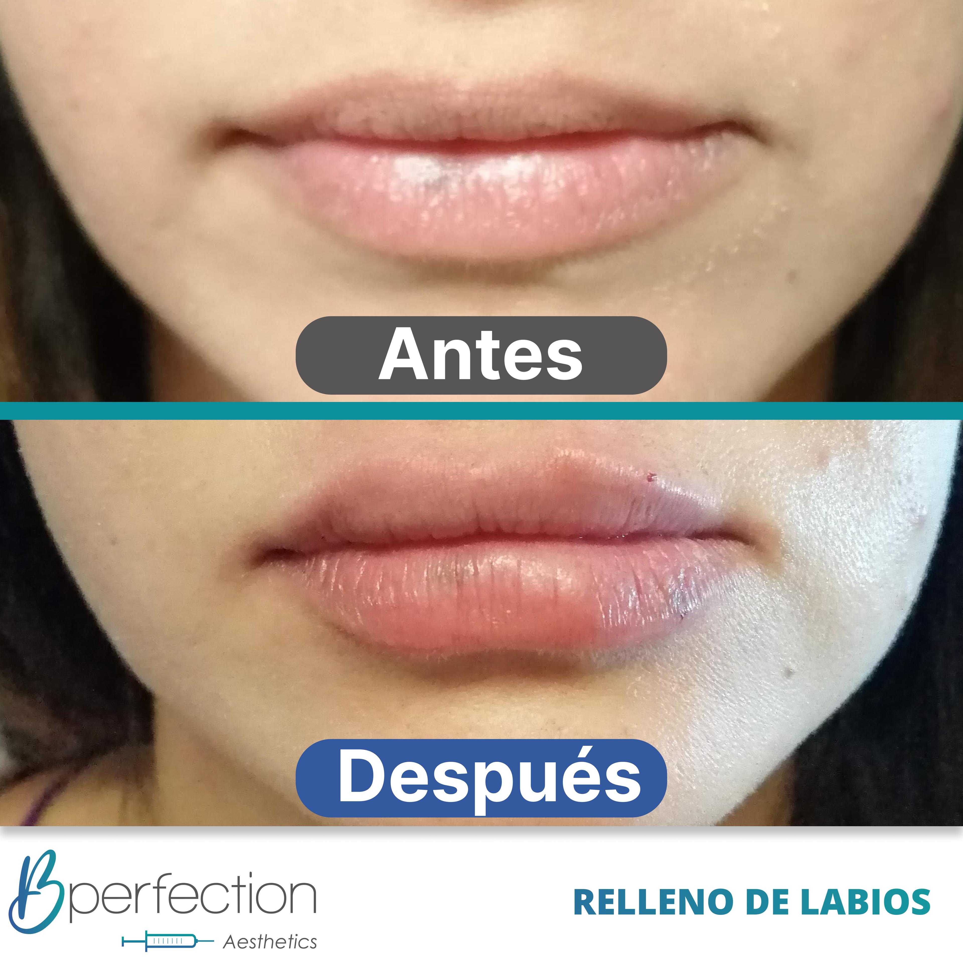 Resultado Labios 2