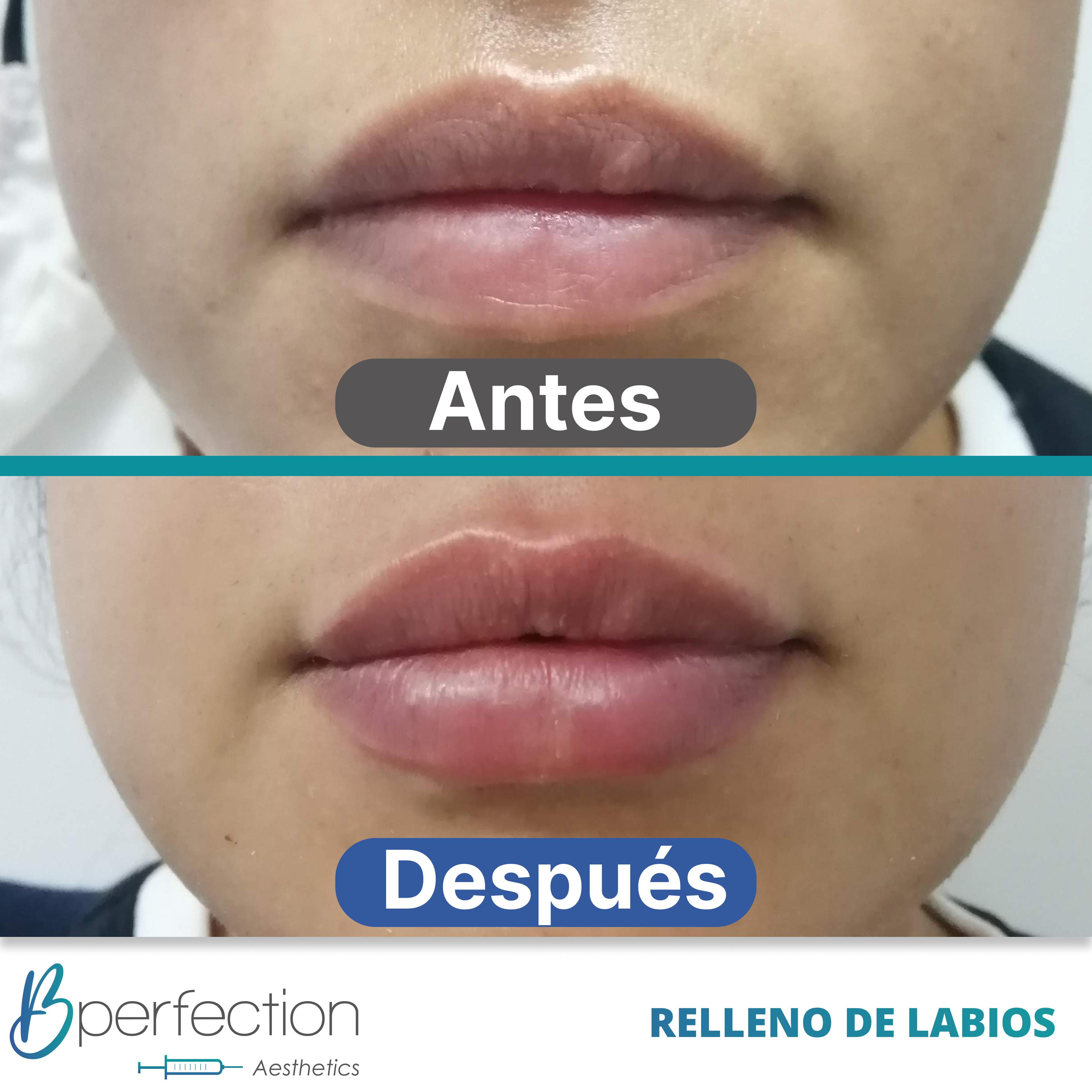 Resultado Labios 3