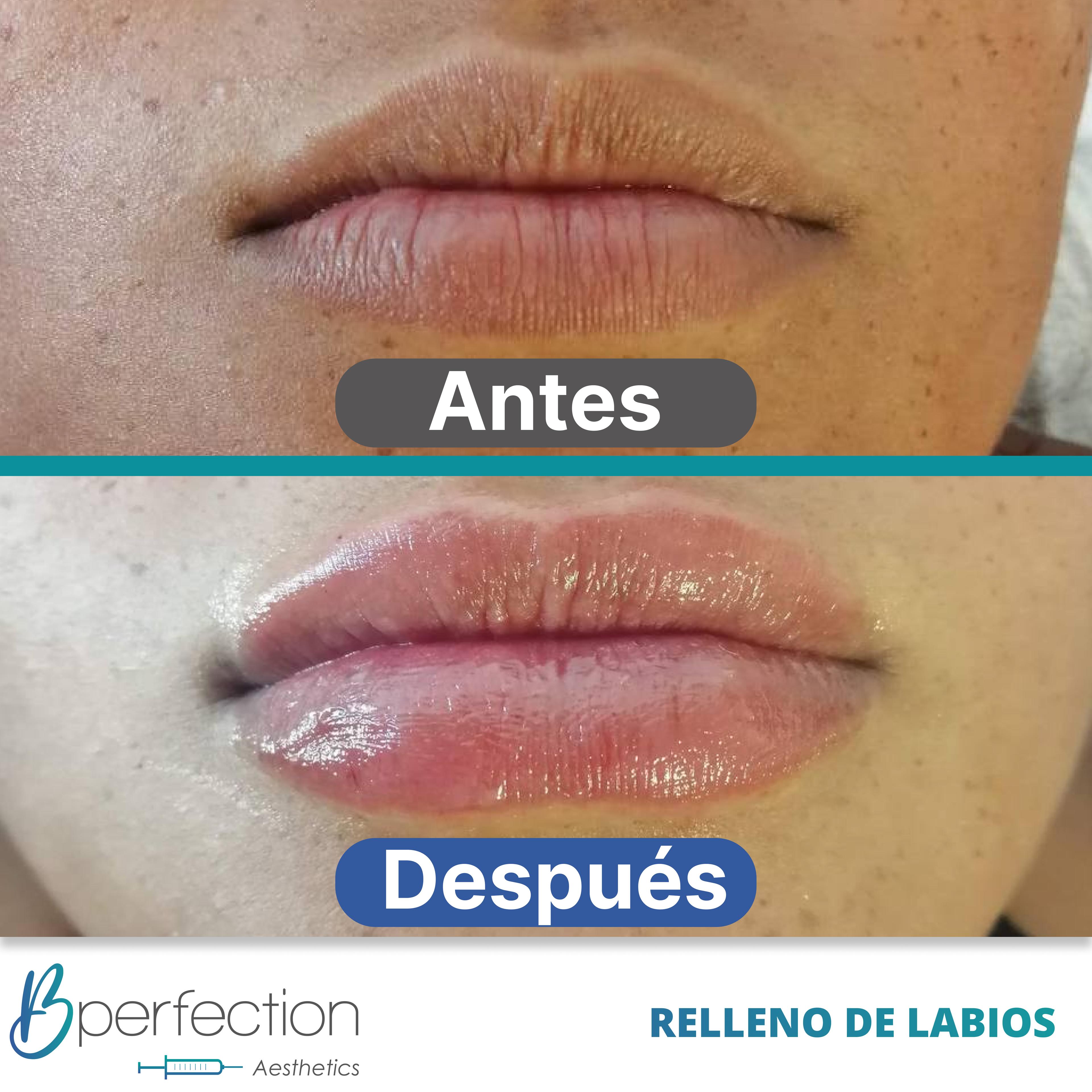 Resultado Labios 4
