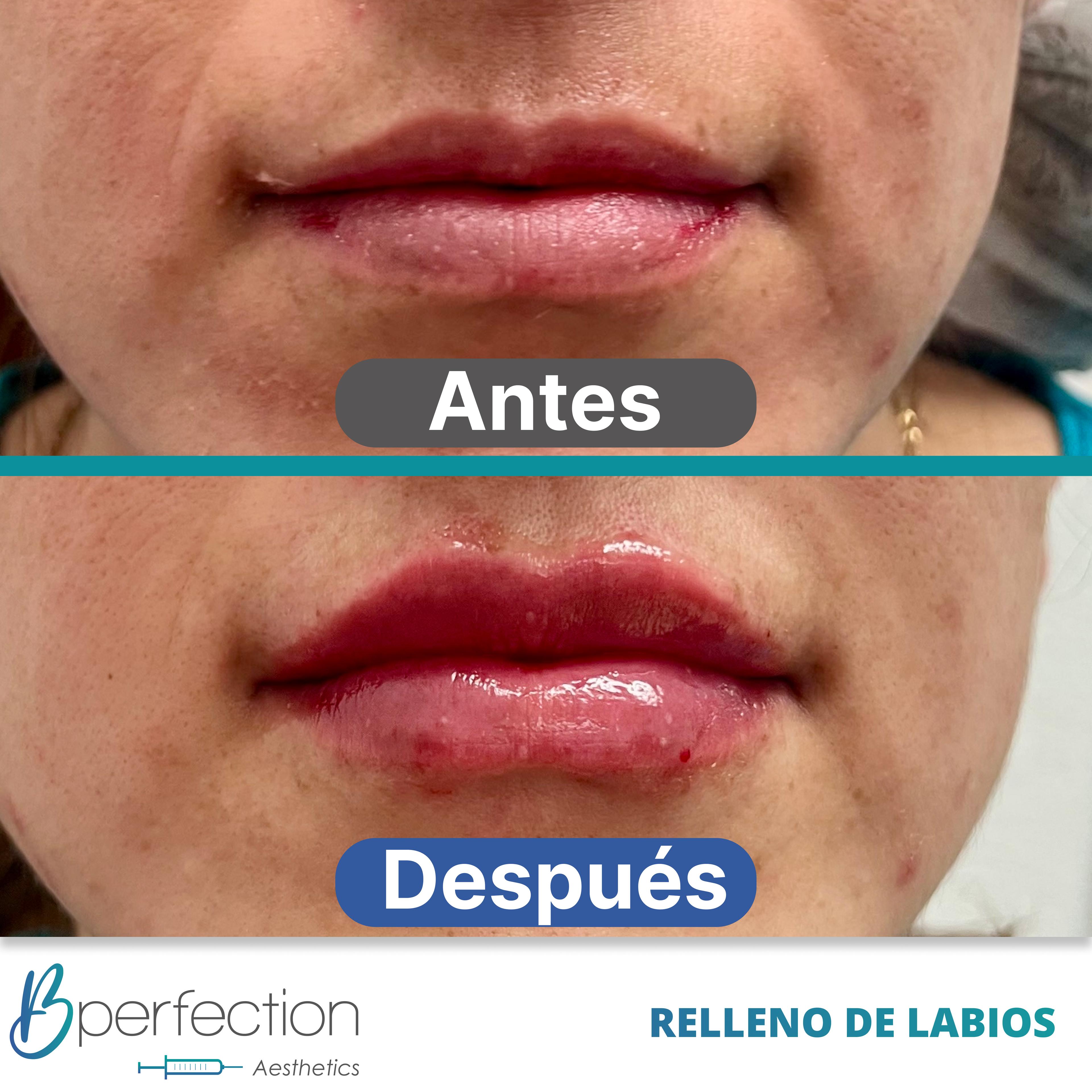 Resultado Labios 5