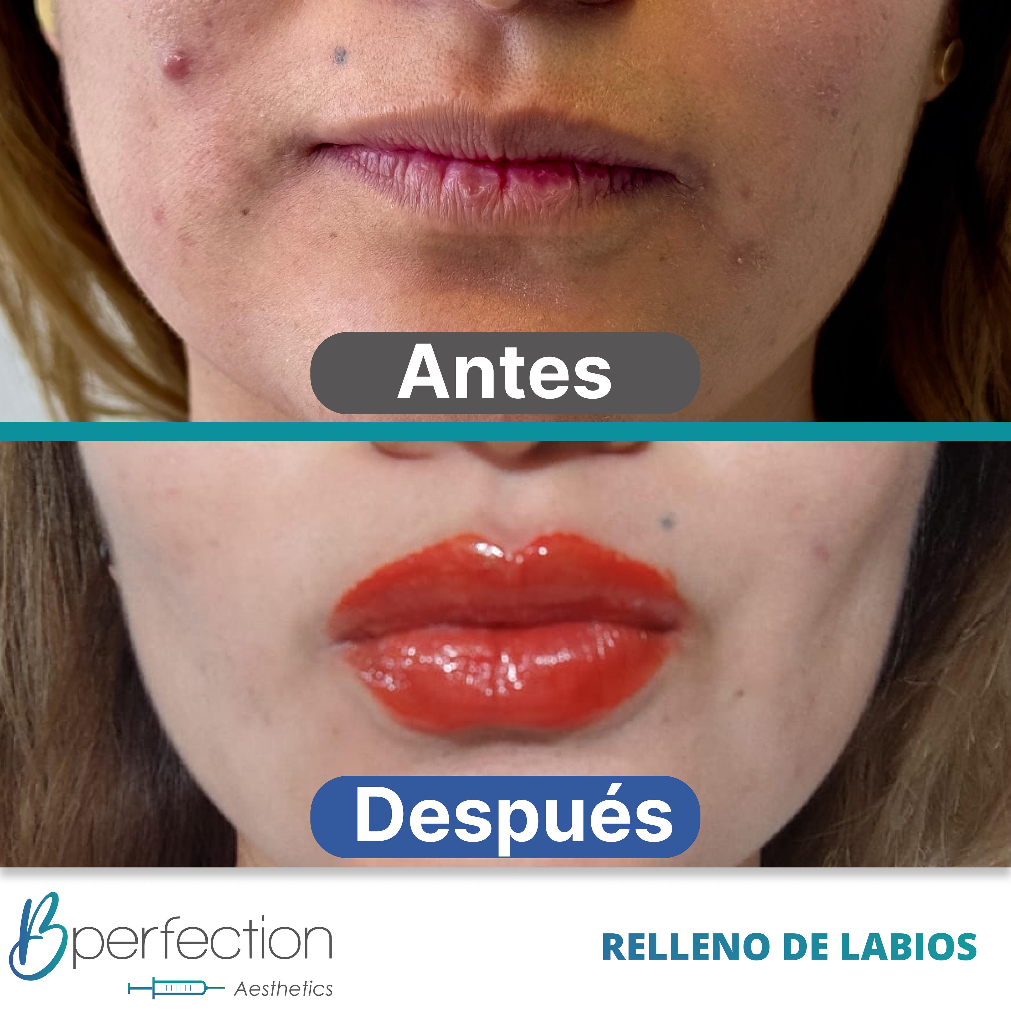 Resultado Labios 6