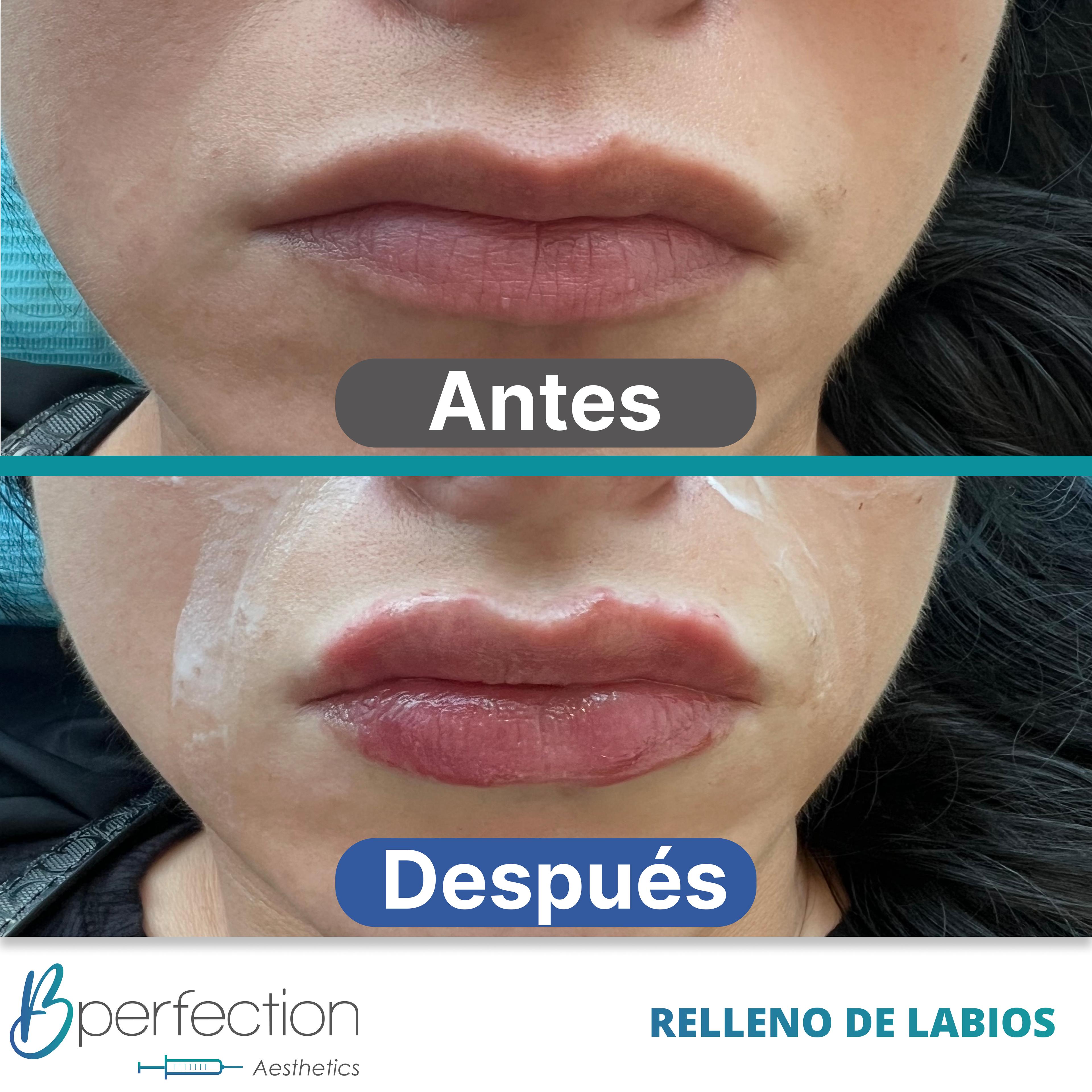 Resultado Labios 7